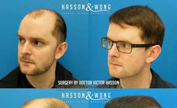 Hair transplantation surgery before and after photos