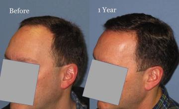 Hair transplantation surgery before and after pictures