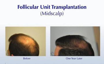 Hair restoration procedure before and after pictures