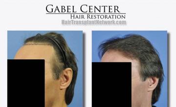 Hair transplant surgery before and after images