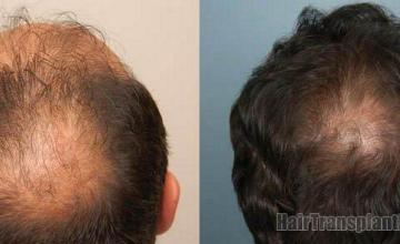 Back - Crown photos of before and after hair transplant