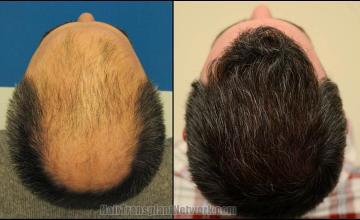 Hair restoration surgery before and after images