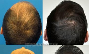 Hair restoration procedure before and after pictures