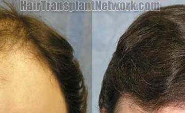 Hair transplantation surgery before and after images