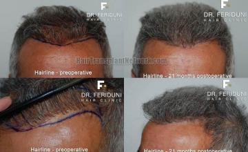 Hair restoration surgery before and after photos