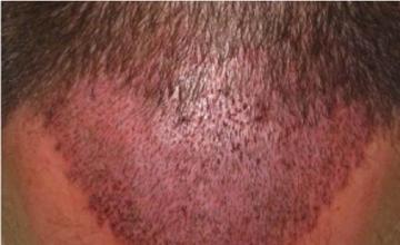 Hair transplantation surgery before and after images