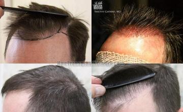 Hair transplantation surgery before and after photos