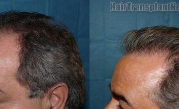 Left view before and after pictures from hair transplant procedure.