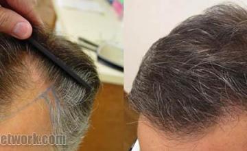 Before and after hair restoration procedure pictures