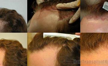 Left view - Hair replacement surgery pictures