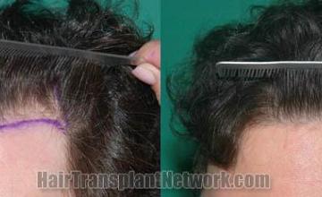 Hair transplantation surgery before and after pictures