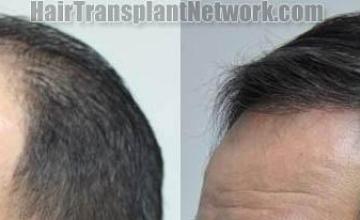 Hair restoration procedure before and after pictures