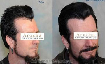 Before and after surgical hair restoration images