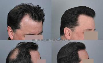 Hair transplantation surgery before and after images