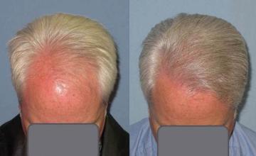 Hair restoration procedure before and after pictures