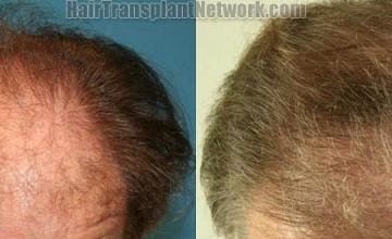 Before and after hair transplantation result photographs