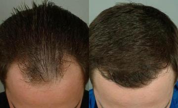 Hair restoration procedure before and after results