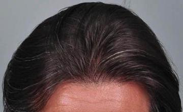 Top view before and after hair restoration results