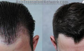 Hair transplantation surgery before and after photos