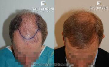 Top view before and after hair restoration results