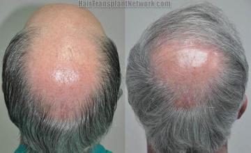 Hair restoration procedure before and after pictures