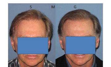 Hair transplant results - Front view before and after