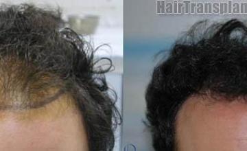 Hair restoration procedure before and after results