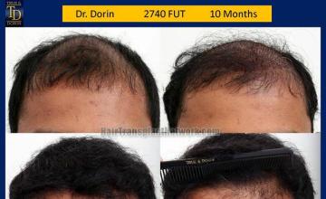 Hair restoration procedure before and after results