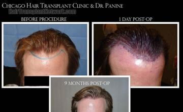 Hair restoration procedure before and after results