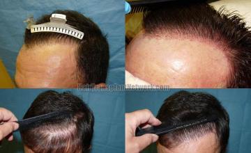 Before and after hair replacement surgery images