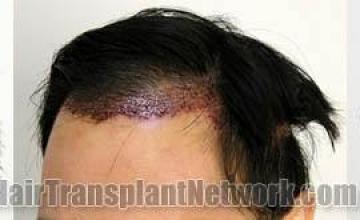 Hair restoration procedure results