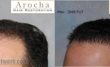 Hair restoration procedure before and after results