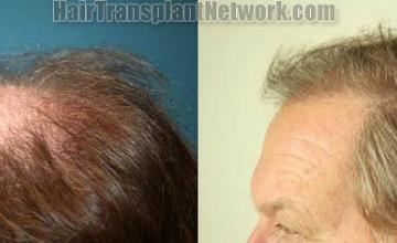 Hair transplantation surgery before and after images