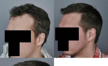 Hair transplantation surgery before and after pictures