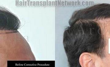 Hair restoration correction surgery to repair old plugs