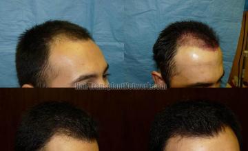 Before and after hair transplantation procedure photos