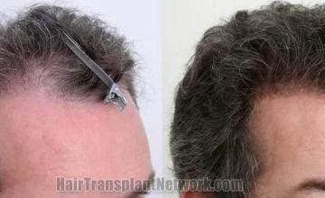 Right view before and after hair transplantation picture