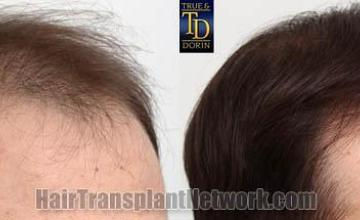 Hair transplantation surgery before and after images