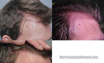 Hair transplantation surgery before and after images