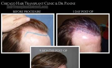 Hair transplantation surgery before and after photos