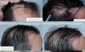 Hair transplantation surgery before and after photos