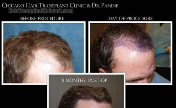 Hair transplantation surgery before and after images