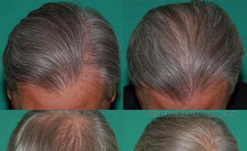 Hair restoration photos showing postoperative results