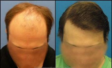 Top view before and after hair restoration results