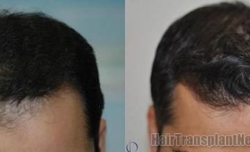 Top view before and after hair restoration results