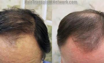 Hair transplantation surgery before and after photos