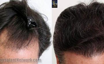 Hair transplantation surgery before and after photos