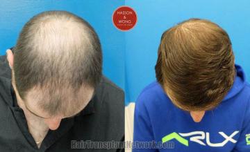 Before and after hair transplant procedure images