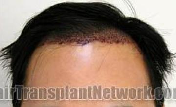  before and after photos