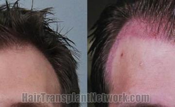 Hair restoration procedure before and after results